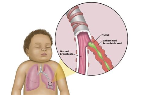 bronquiolite bebe